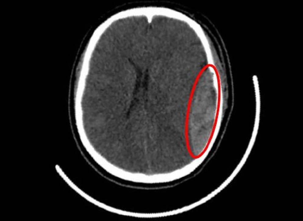 Bánh xe cuốn tà áo dài, nữ sinh bị đập đầu xuống đường nứt hộp sọ- Ảnh 1. Hình ảnh kiểm tra ghi nhận vị trí nứt hộp sọ, máu tụ dưới màng cứng nữ sinh gặp phải